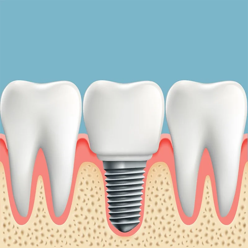 info about dental implants